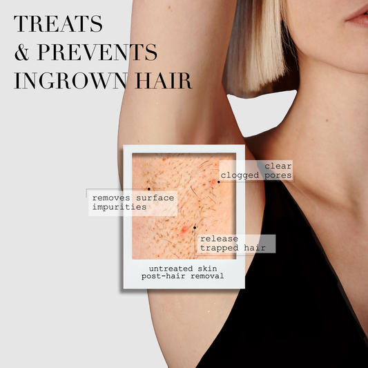The ingrown bar