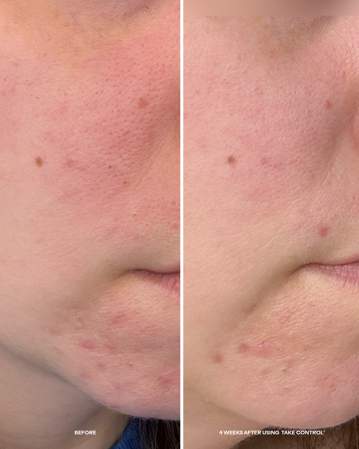 Take Control™ Salicylic + 10% Azelaic Acid Clarifying Serum